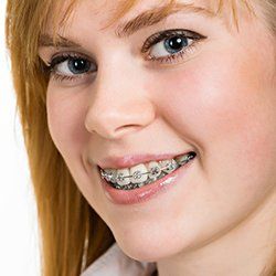 fixed braces