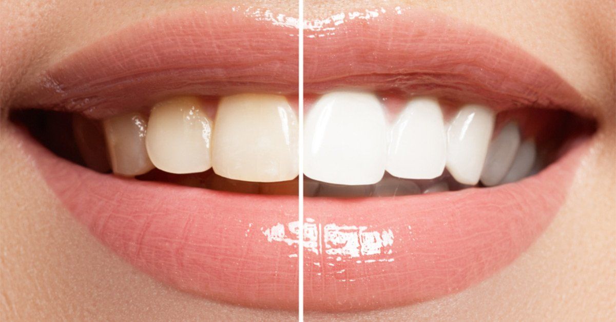 Teeth Whitening Aftercare