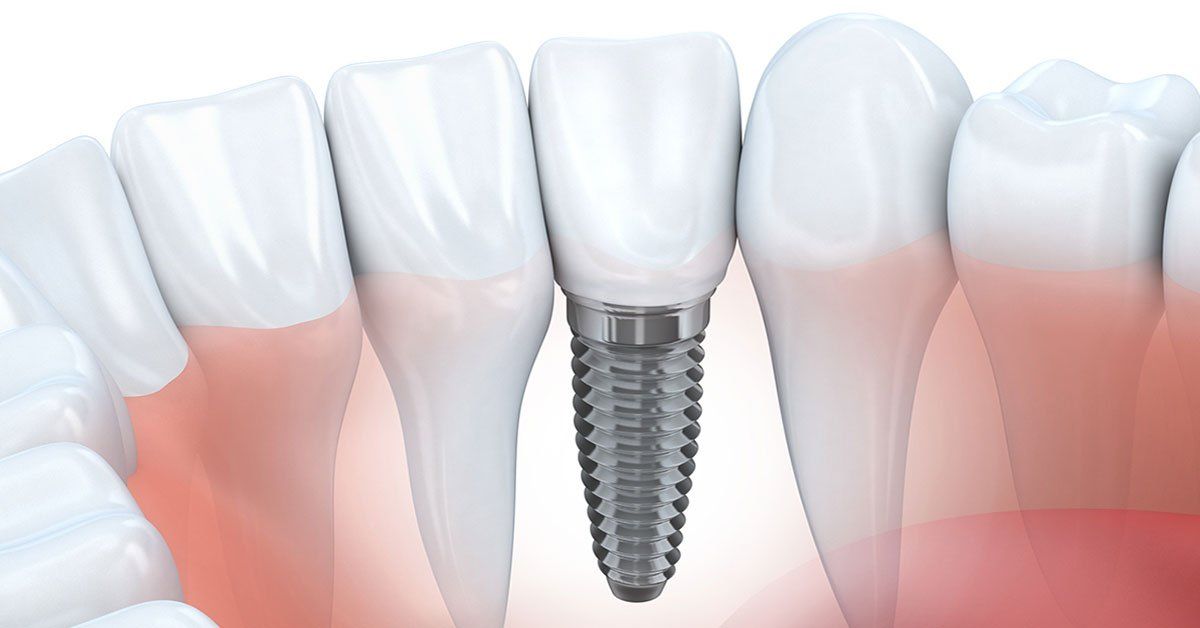 tooth implant process