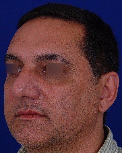 male rhinoplasty