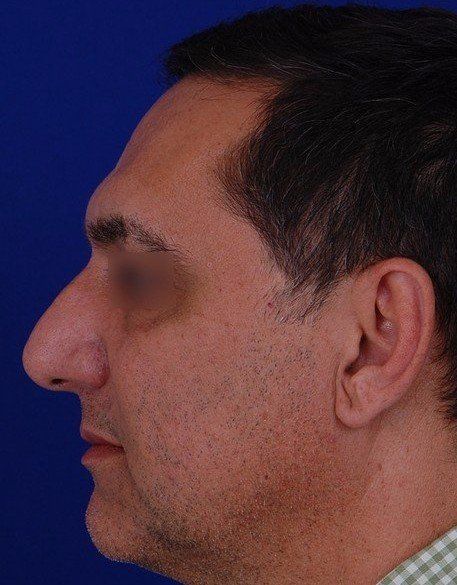 male rhinoplasty