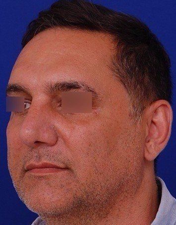 male rhinoplasty
