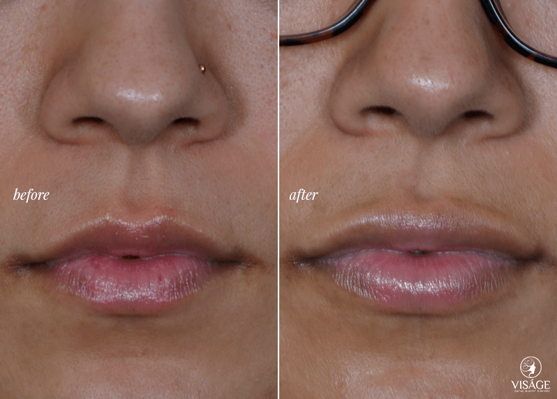 PermaLip before and after