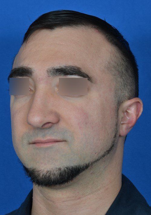 male rhinoplasty 