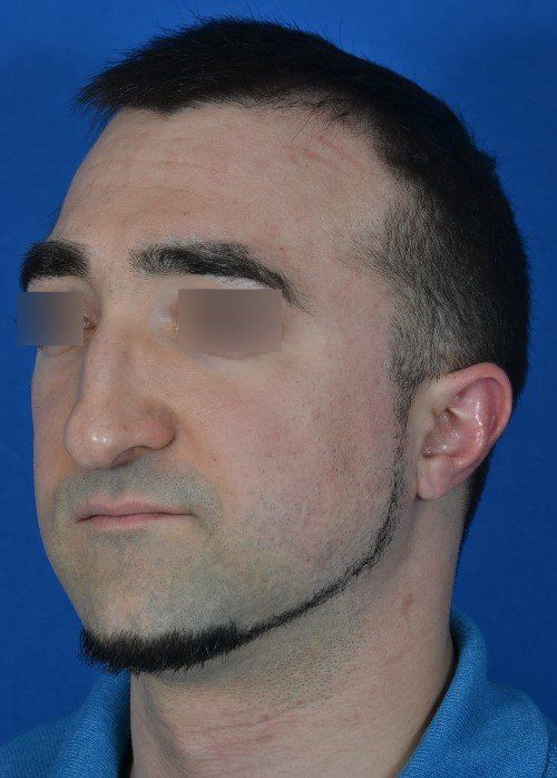 male rhinoplasty 