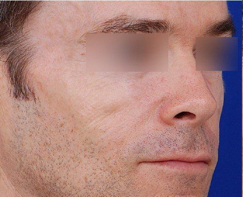 man before cheek filler