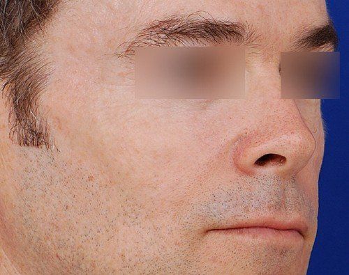 man after cheek filler