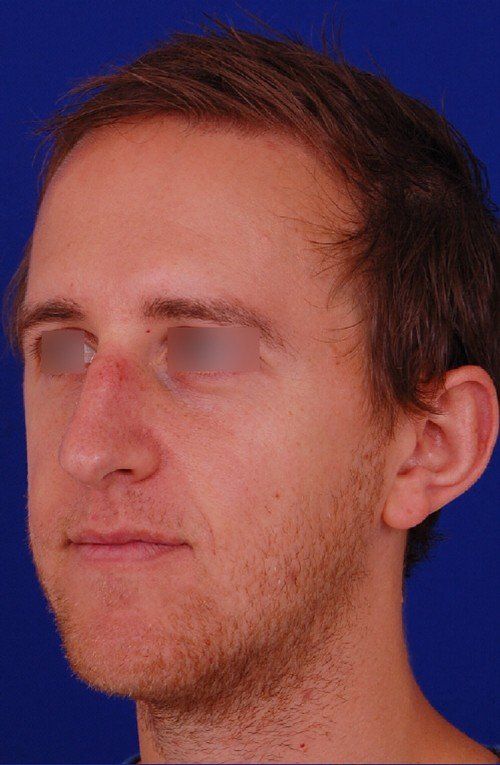 male rhinoplasty 