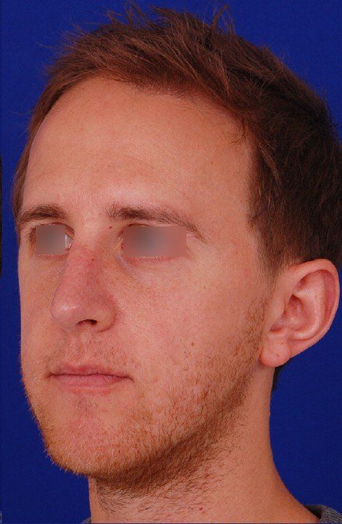 male rhinoplasty 