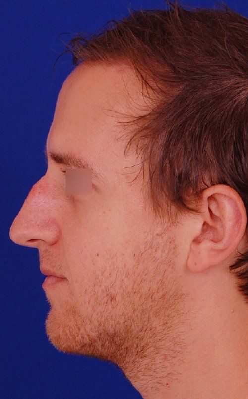 male rhinoplasty 