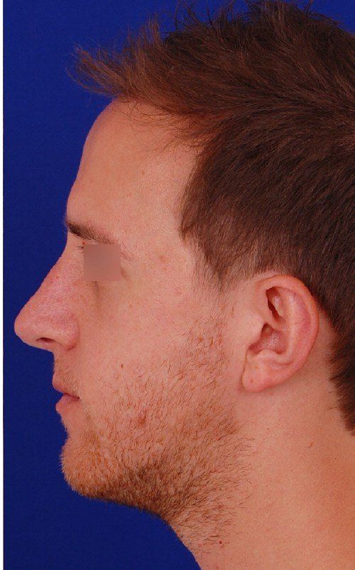 male rhinoplasty 