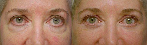 side by side before/after eyelid surgery