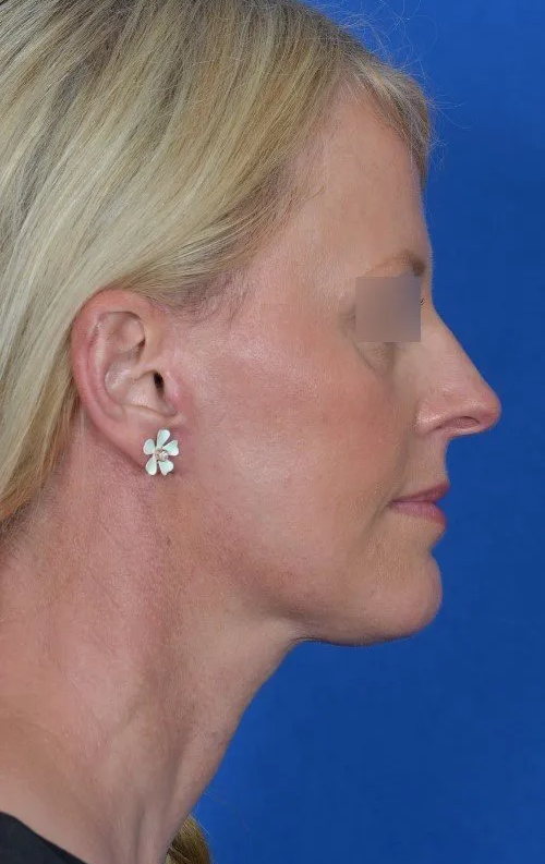 rhinoplasty before and after