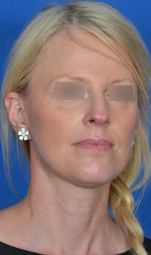 rhinoplasty before and after