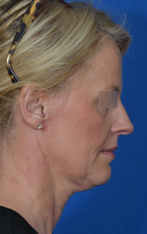 rhinoplasty before and after