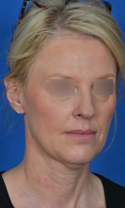 rhinoplasty before and after