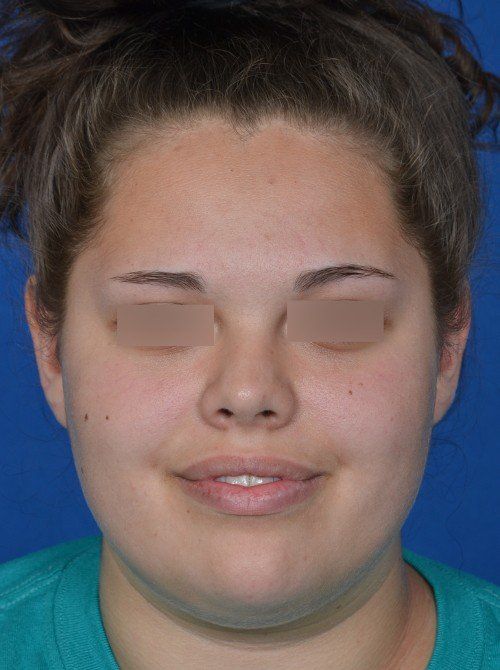 otoplasty before and after