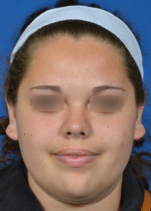 otoplasty before and after