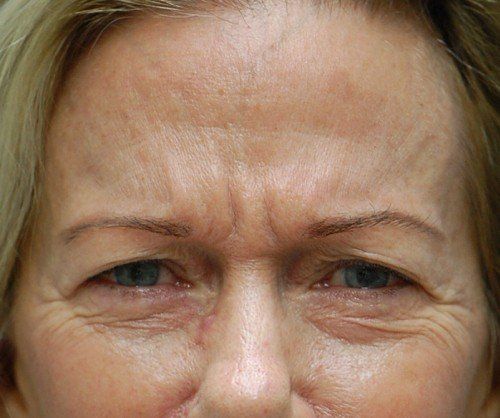 frown lines before botox