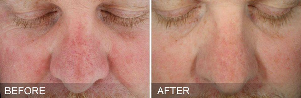 before and after dermaplaning