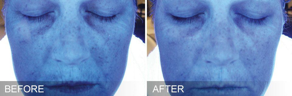 before and after dermaplaning
