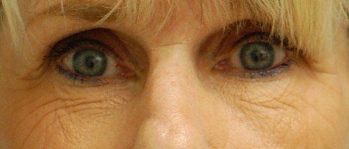womans eyes before laser resurfacing 