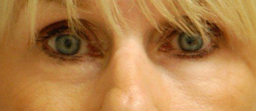 womans eyes after laser resurfacing 