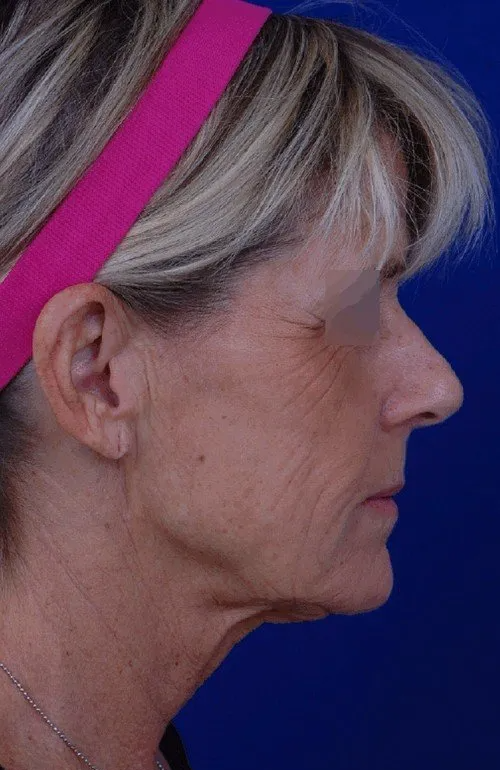 facelift-before-after-lower-face-tightening.jpg