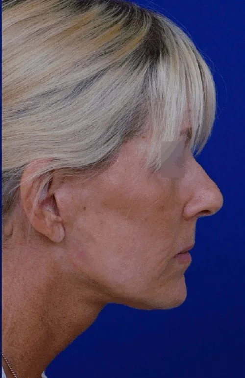 before-after-lower-face-tightening.jpg
