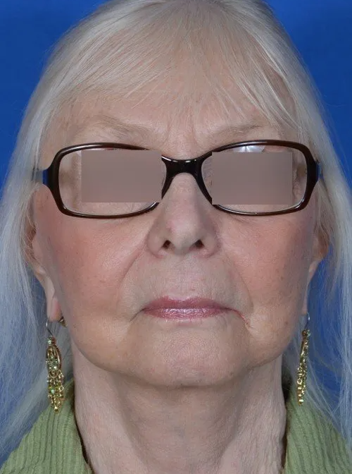 after facelift older woman