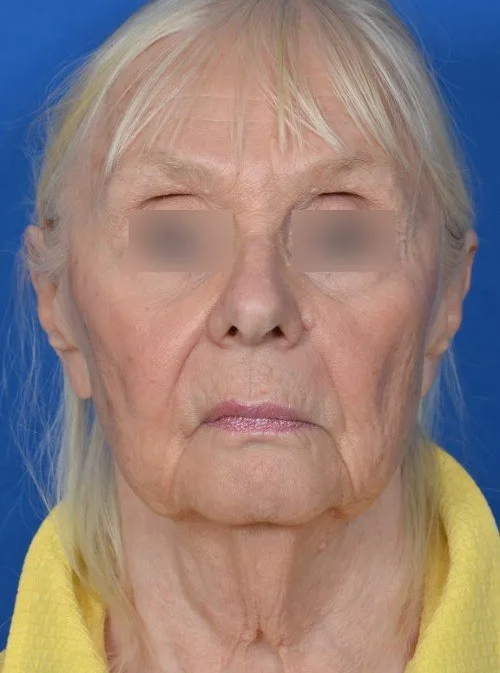 before facelift older woman