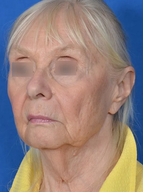 before and after facelift