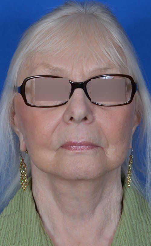 before and after facelift