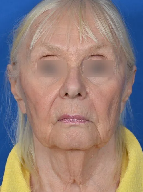 before and after facelift