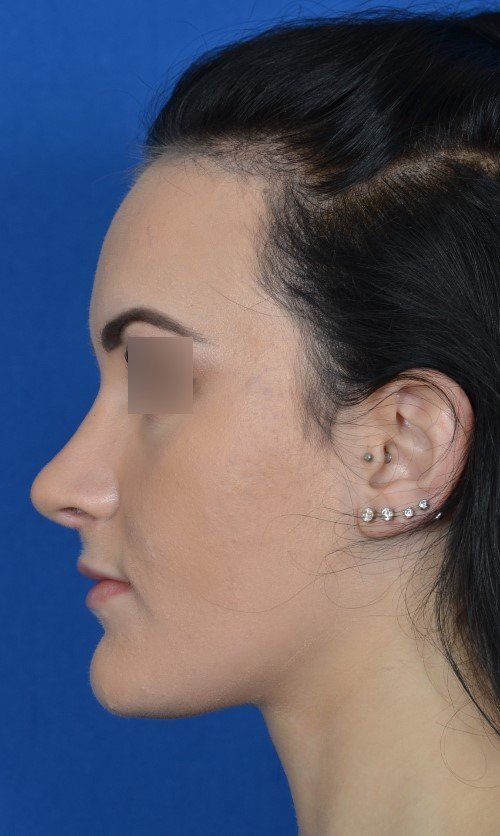 rhinoplasty before and after