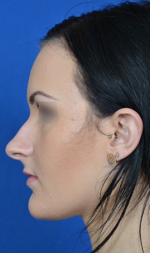 rhinoplasty before and after