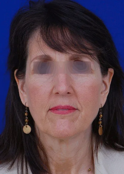 rhinoplasty before and after