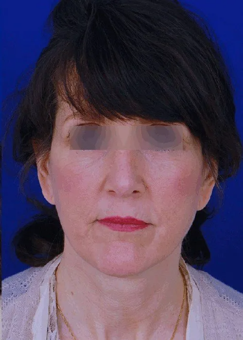 rhinoplasty before and after