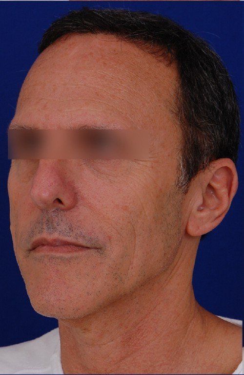 male rhinoplasty 
