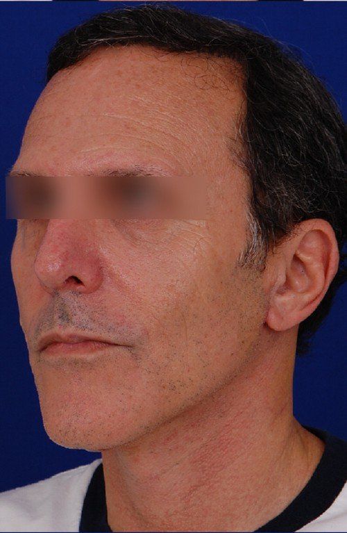 male rhinoplasty 