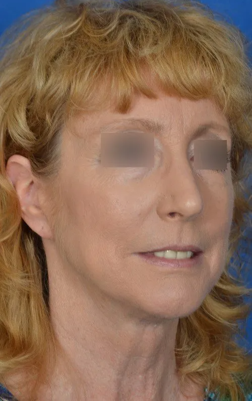 woman after mini lift