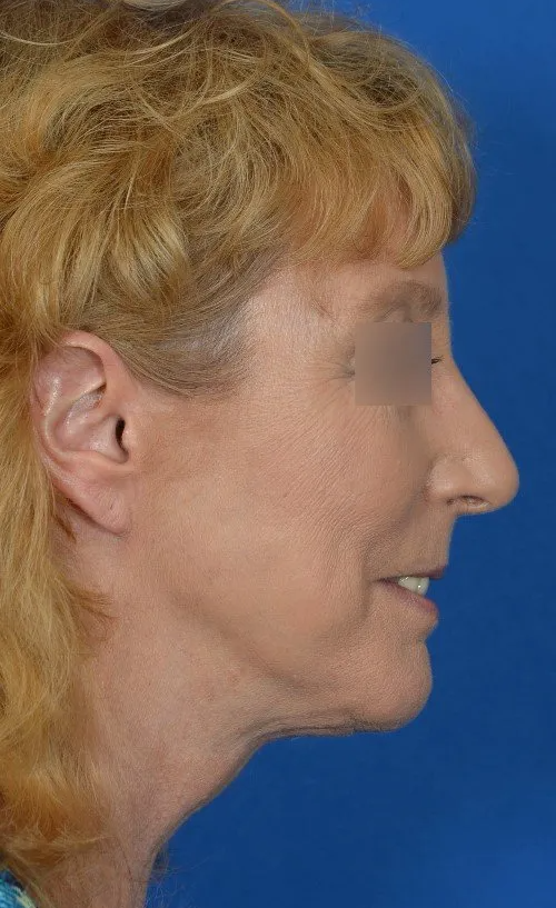 woman after mini lift