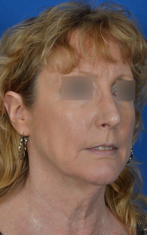 woman before mini lift