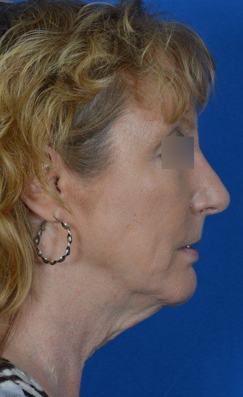 woman before mini lift