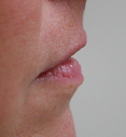 before lip implants