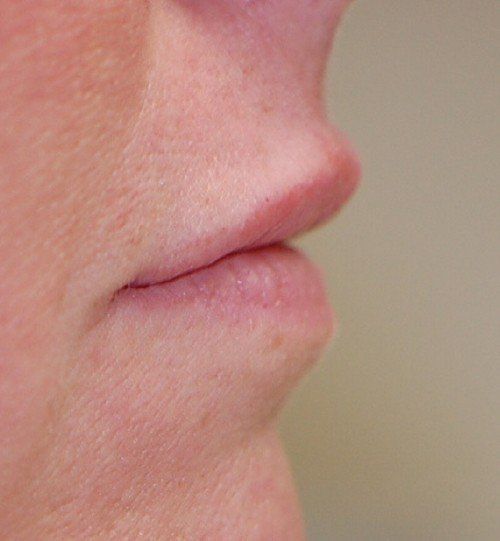 after lip implants