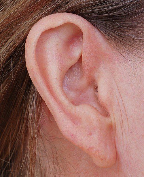 before earlobe surgery