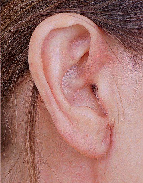 after earlobe surgery
