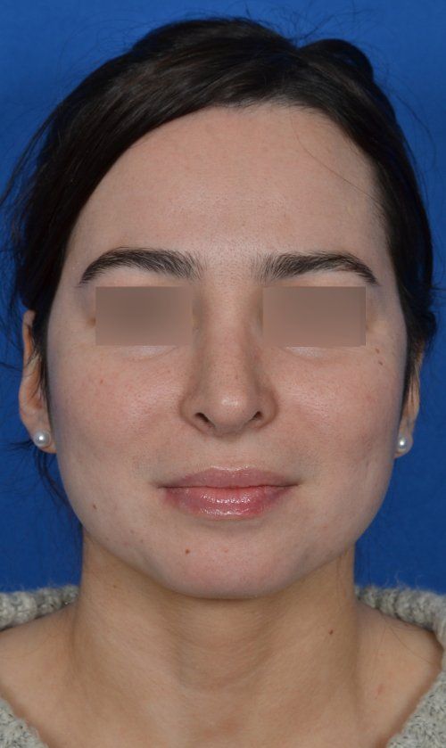 female rhinoplasty