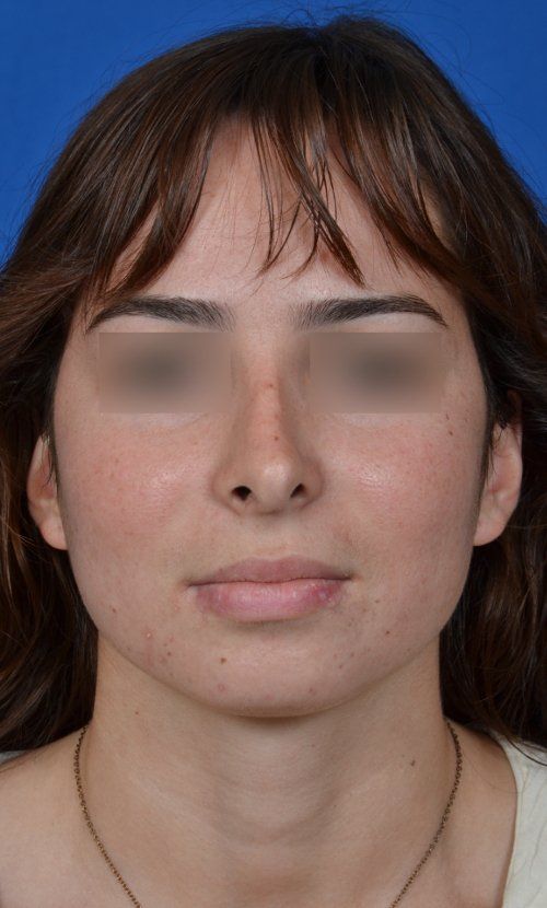 female rhinoplasty